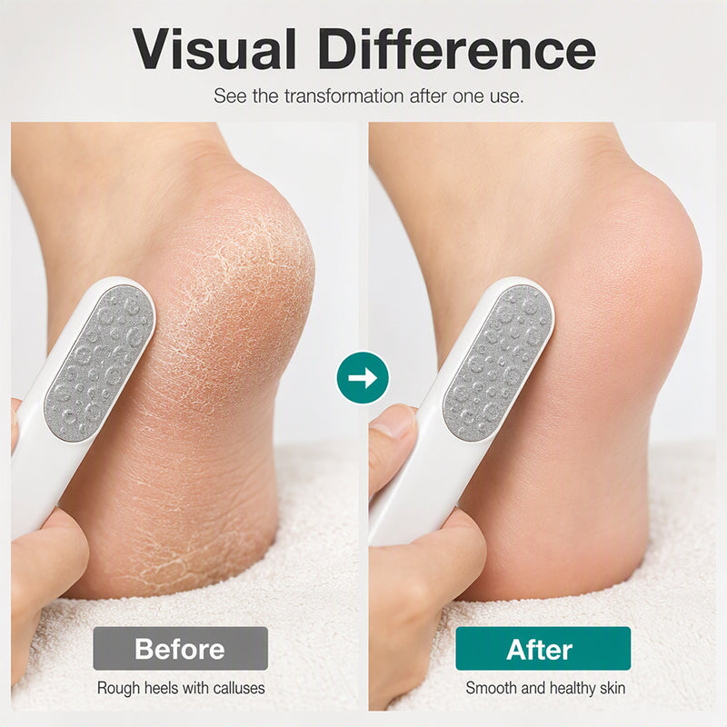 Dual-Sided Foot File Callus Remover
